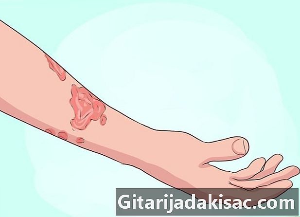 Как да се диагностицира псориазис на скалпа