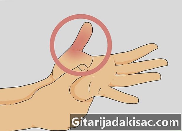 Cách chẩn đoán ngón tay cái bị gãy