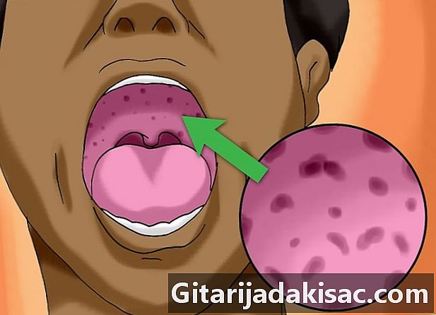 Kuinka erottaa bakteeriperäinen tonsilliitti ja virus tonsilliitti