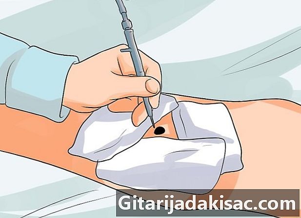 Como remover uma toupeira