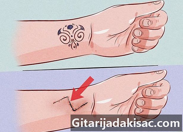 Hvordan fjerne en tatovering