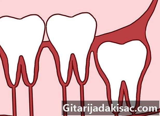 Como saber a diferença entre um dente do siso em erupção e incluído