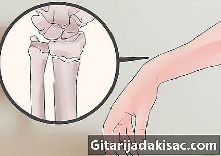 Paano masasabi ang pagkakaiba sa pagitan ng isang sprain at isang bali ng pulso