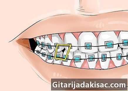 Как да фиксирате еластична лента към зъбните си пръстени