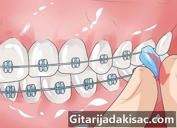 Cum să te descurci cu inelele dentare care doare