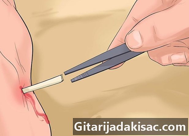 가오리 또는 성게로 인한 부상을 식별하고 치료하는 방법