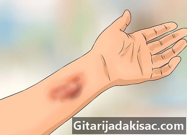 Ako identifikovať príznaky žltačky