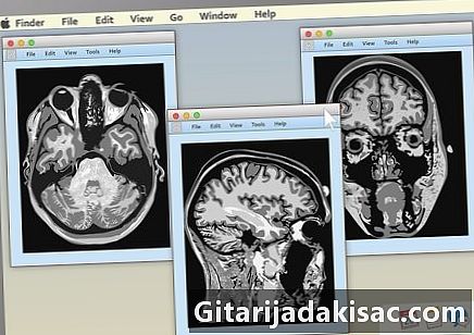 磁気共鳴画像法（MRI）検査の結果を解釈する方法