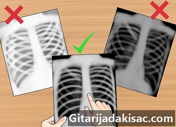 Göğüs röntgeni nasıl yorumlanır?